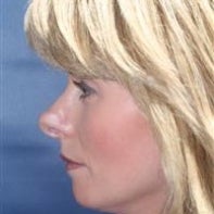 Revision Rhinoplasty