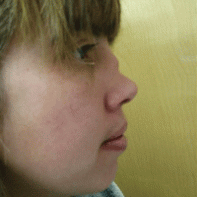 Revision Rhinoplasty