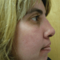 Revision Rhinoplasty