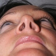 Revision Rhinoplasty