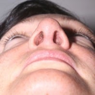 Revision Rhinoplasty