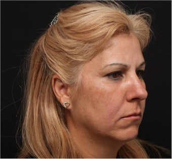 Restylane & Juvederm