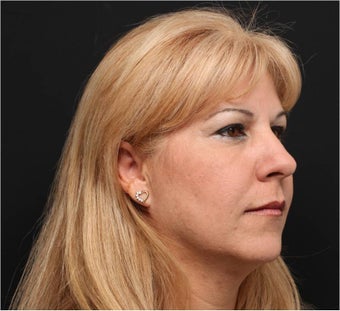 Restylane & Juvederm