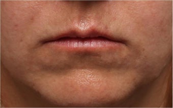 Restylane