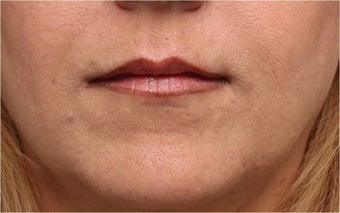 Restylane