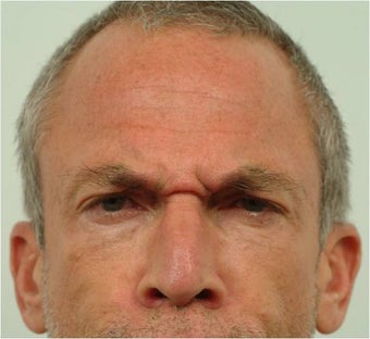 Botox between the eyebrows and across the forehead