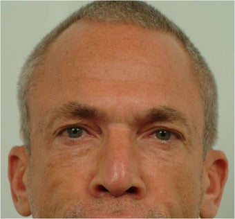 Botox between the eyebrows and across the forehead