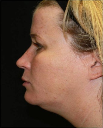 Ultherapy