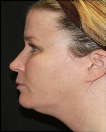 Ultherapy