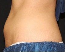 Coolsculpting-lower abdomen