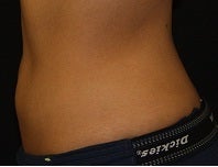 Coolsculpting-lower abdomen