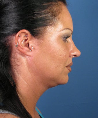 Liposuction