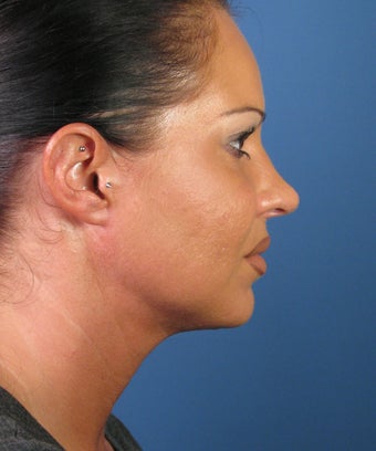 Liposuction