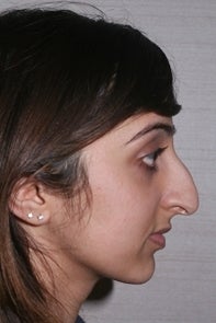 Asian Rhinoplasty