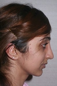 Asian Rhinoplasty