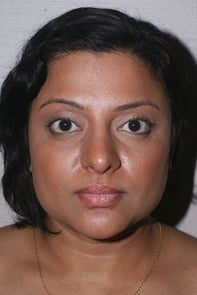 Asian Rhinplasty