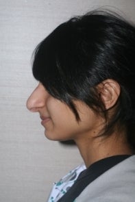 Asian Rhinoplasty