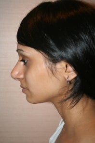 Asian Rhinoplasty