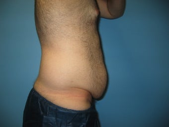 Male tummy tuck
