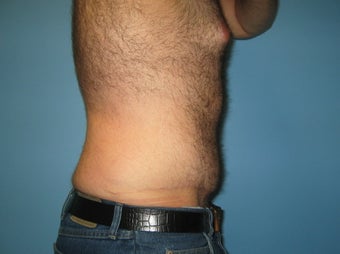 Male tummy tuck