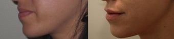 Lip Enhancement