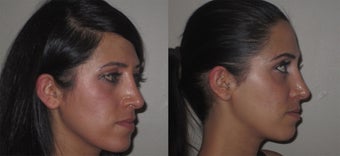 Facial Rejuvenation, non-surgical