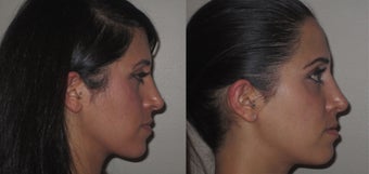 Facial Rejuvenation, non-surgical