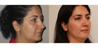Facial Rejuvenation, non-surgical