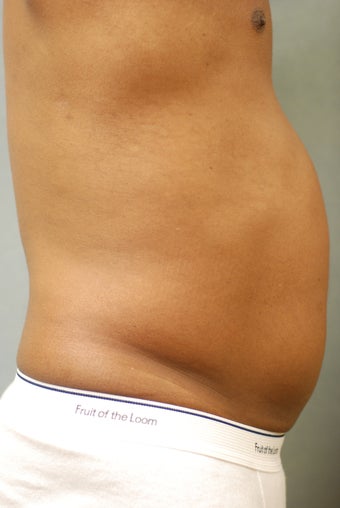 SmartLipo™  Restoration of a Male's Abs 