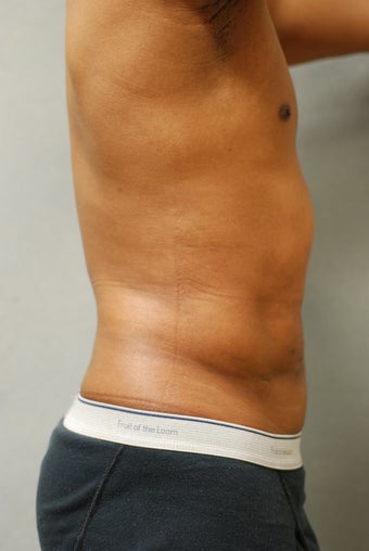 SmartLipo™  Restoration of a Male's Abs 
