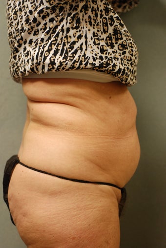 SmartLipo™  65 Yr Old Female  Abs/upper & Lower Flanks, Waist