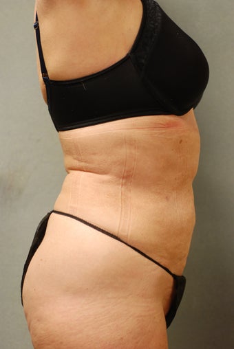 SmartLipo™  65 Yr Old Female  Abs/upper & Lower Flanks, Waist