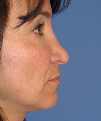 Revision Rhinoplasty