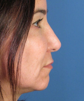Revision Rhinoplasty