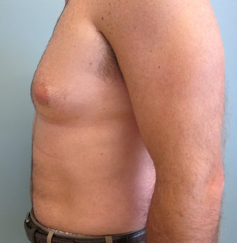 Liposuction of Abdomen, Love handles, Flanks, Chest
