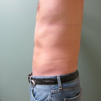 Liposuction of Abdomen, Love handles, Flanks, Chest