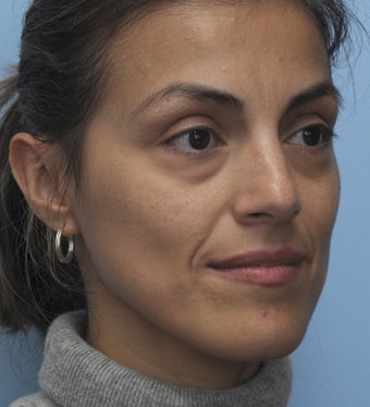 Eye Dermafillers,Cheek Dermafillers,Facial Dermafillers