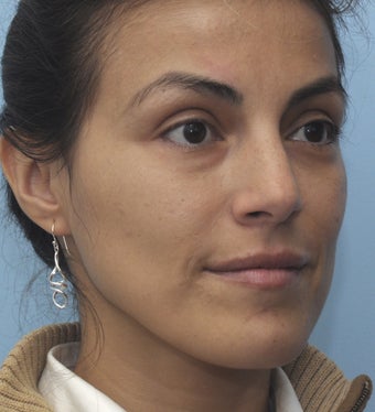 Eye Dermafillers,Cheek Dermafillers,Facial Dermafillers