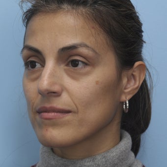 Cheek Dermafiller, Under Eye Dermafiller, Face Dermafiller