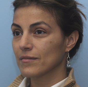 Cheek Dermafiller, Under Eye Dermafiller, Face Dermafiller