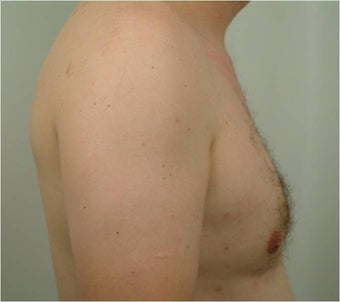 Smart Lipo of the chest