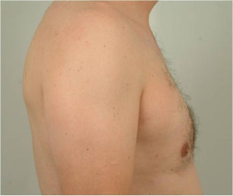 Smart Lipo of the chest