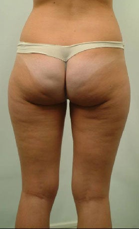 Laser Liposuction of Thighs