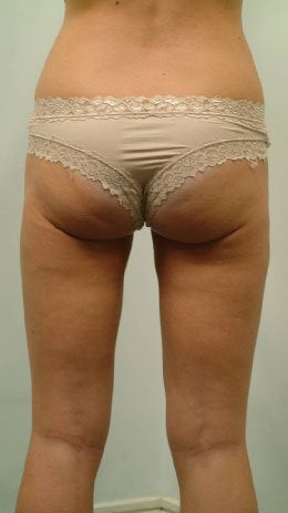 Laser Liposuction of Thighs