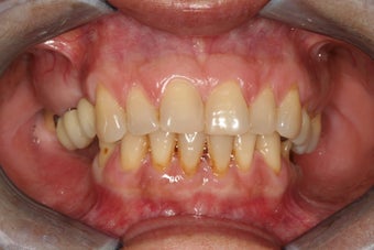 Implant restorations of posterior segments on the top and bottom