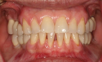 Implant restorations of posterior segments on the top and bottom