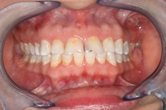 All-ceramic crowns for anterior teeth