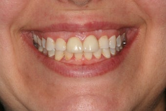 All-ceramic crowns for anterior teeth