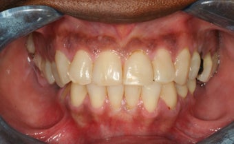 Full mouth reconstruction, smile makeover