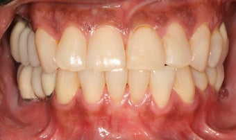 Full mouth reconstruction, smile makeover